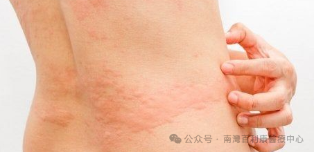 帶狀疱疹